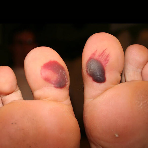 blood-blister-on-foot-blood-blister-on-toe-causes-treatment