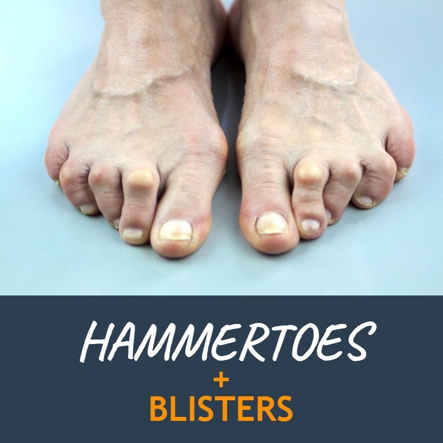 hammertoes and blisters